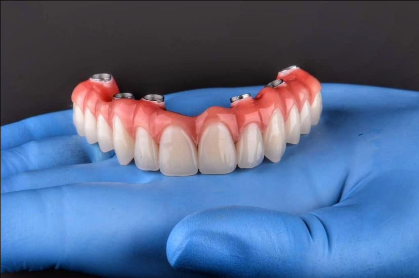 Fazer implantes dentários antes ou depois do tratamento