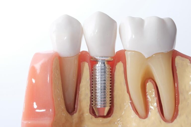 Implante Dent Rio Tudo Que Voc Precisa Saber Sobre O Tratamento
